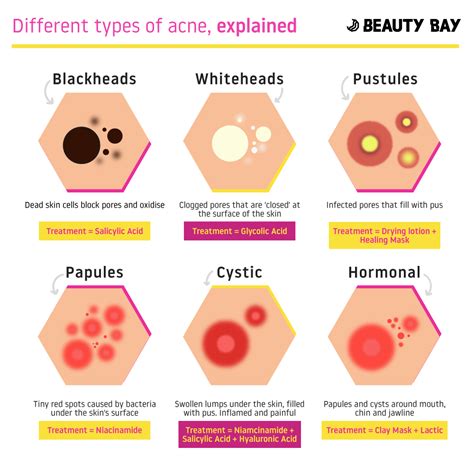 6 Different Types Of Acne Explained Beauty Bay Edited