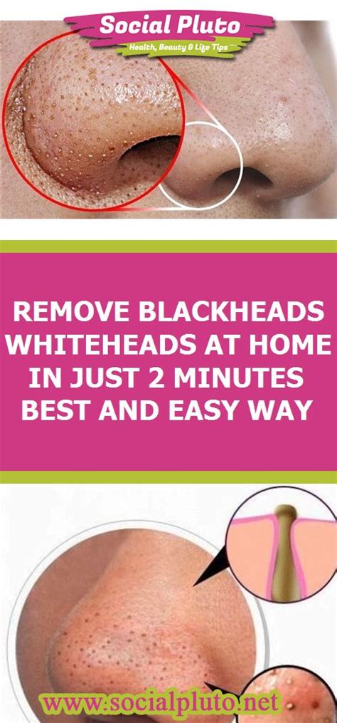 Remove Blackheads Whiteheads At Home In Just 2 Minutes Best And Easy