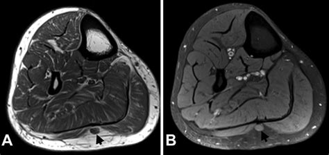 Preoperative T1 Weighted Mri Shows The Neuroma Of The Sural Nerve