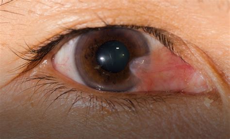 Pterygium Causes Symptoms Diagnosis Treatment And Pterygium Eye Surgery