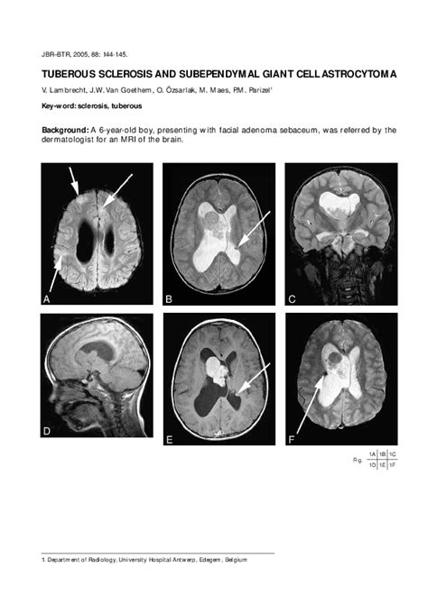Pdf Tuberous Sclerosis And Subependymal Giant Cell Astrocytoma P