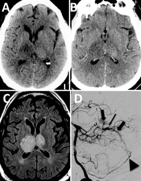 Dural Arteriovenous Fistulainduced Thalamic Dementia Neurosurgery Blog