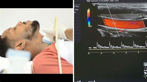 Carotid And Vertebral Arteries Doppler Ultrasound Protocols Youtube