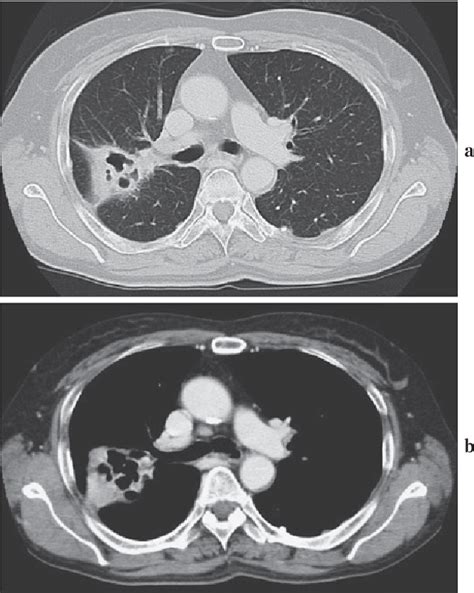 Figure 2 From A Case Of Pulmonary Actinomycosis Which Was Difficult To