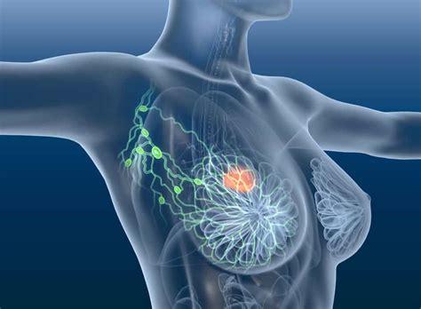 Learn about liver cancer treatments and survival rate facts online. Breast Cancer: A Female Naturopath's Perspective