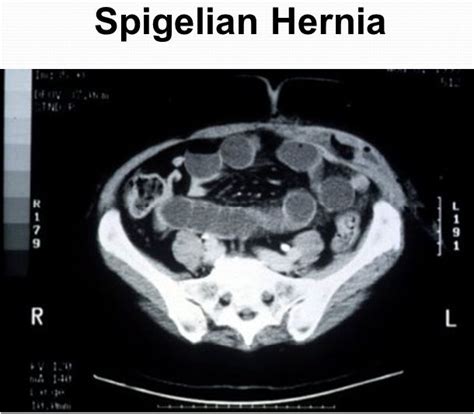 Spigelian Hernia Symptoms Ct Pictures Causes Repair Procedure