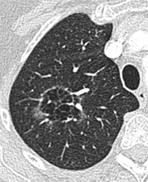 Lung Cancers Associated With Cystic Airspaces Underrecognized Features