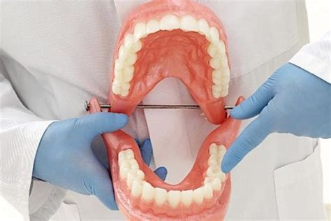 Implan gigi, atau gigi tanam, adalah sekrup titanium yang ditanam pada rahang. Mengapa Kami Memiliki Begitu Banyak Masalah Dengan Gigi ...