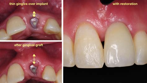 All tissue is harvested within 24 hours of donor death with ideal donors aging from 15 to 40 years old. Gingival Graft for Increasing Gingival Thickness / Quality ...