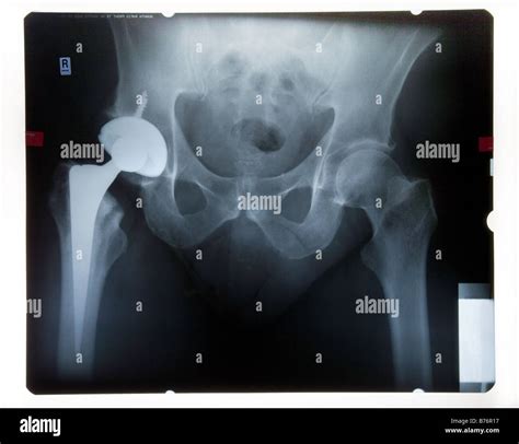 X Ray Of Male Pelvis With Artificial Hip Stock Photo Alamy