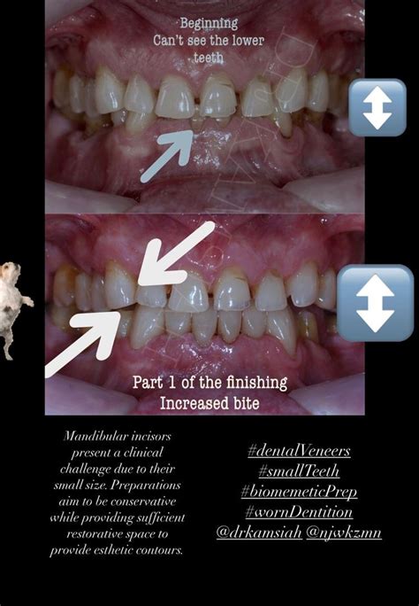 Treatment Of Worn Lower Dentition Dr Kamsiah Dental Clinic