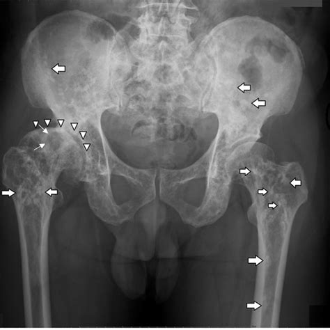 Coronal Mri Of Both Hips A Subchondral Cyst Within The Right Femoral