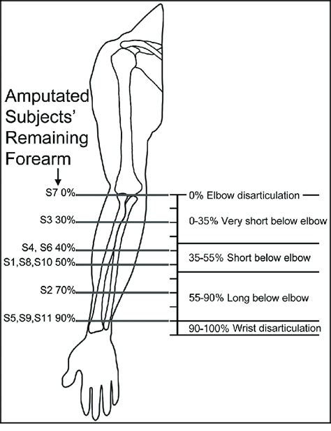 Remaining Forearm Percentage Of Subjects With Amputation S Subject