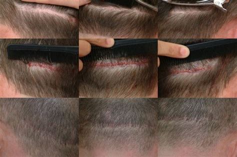 Strip Scars Repair Fue Into Strip Scars Hair Transplant Hairsite