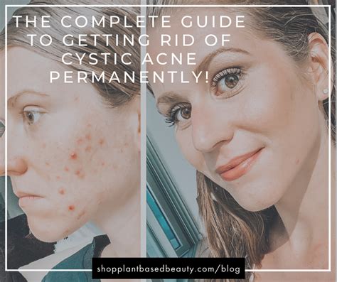 Part 1 Hormonal Cystic Acne The Root Cause And 5 Steps To Treat It