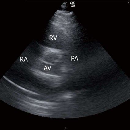 Subcostal Right Ventricular Inflow Outflow View Showing The Body Of A