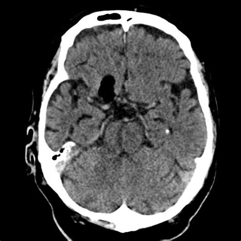 Intracranial Dermoid Cyst Radiology Reference Article Radiopaedia