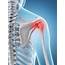 Diagnosing And Treating Rotator Cuff Tears  The Orthopedic & Sports