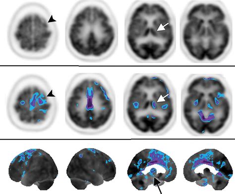 Brain Pet In Suspected Dementia Patterns Of Altered Fdg Metabolism