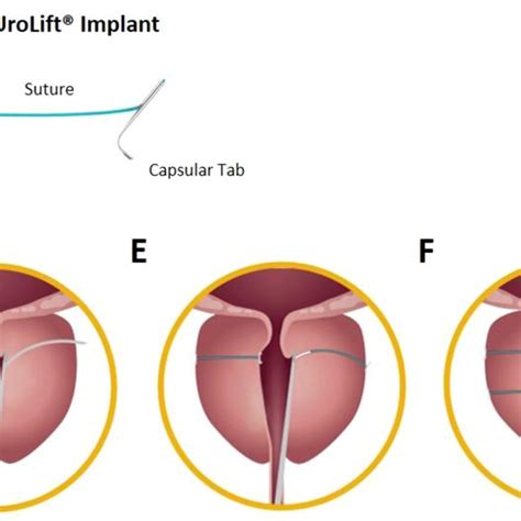 Atrophic Response Following UroLift Implant Placement A Mild Fibrosis Download Scientific