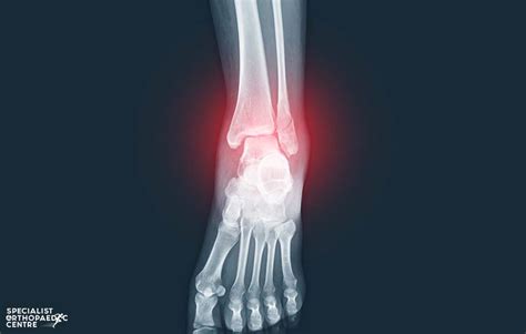 Orthopaedic Surgeon Singapore All You Need To Know About Fractures