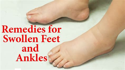 Home Remedies For Swollen Feet