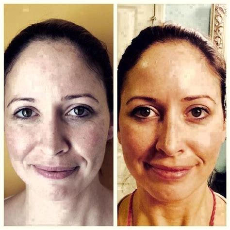 Microcurrent Facial Treatment Before And After 5