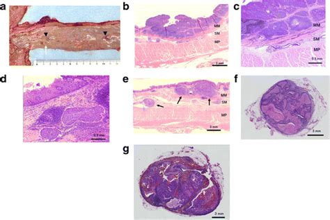 Macroscopic And Pathological Findings Of The Resected Specimen A