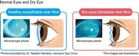 The asia dry eye society classification report suggests that for a practical use of the definition, diagnostic criteria and classification system should be integrated and be simple to use. Dry Eye | Asia | For Patients | Santen Pharmaceutical