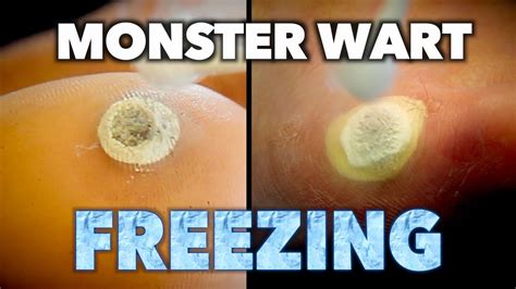 2 monster warts vs 1 mother and son frozen with liquid nitrogen dr paul youtube