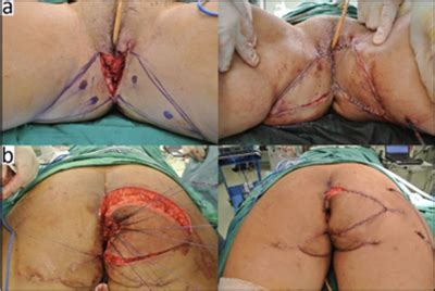 Triple Vy Advancement Flap For Vulva And Anal Reconstruction In