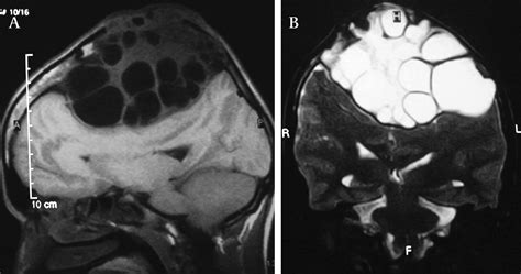 Primary Multiple Calvarial Hydatid Cysts—a Rare Occurrence Journal Of