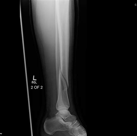 Cureus Fracture Nonunions And Delayed Unions Treated With Low