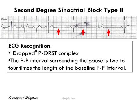 Sinoatrial Block Type Cardiology Diagnosis Ekg Grepmed