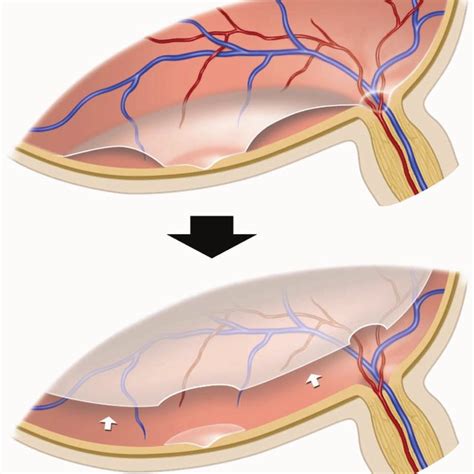 Classification Of A Shallow Posterior Vitreous Detachment PVD Type