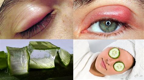 Effective Natural Home Remedies For Swollen Eyes Home Remedies Puffy