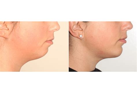16 Facial Liposuction And Chin Augmentation Dr Denton