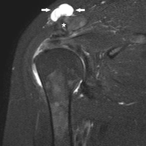 Pdf Shoulder Ganglion Cysts In Mri Accompanying Tendon Pathologies