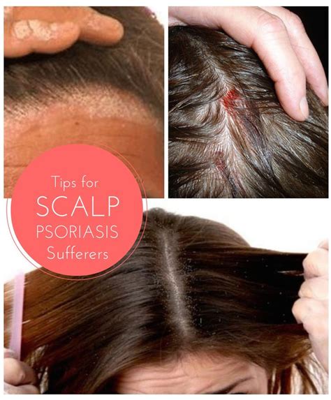 Scalp Psoriasis Is A Relatively Common Condition Affected Around 2 Of