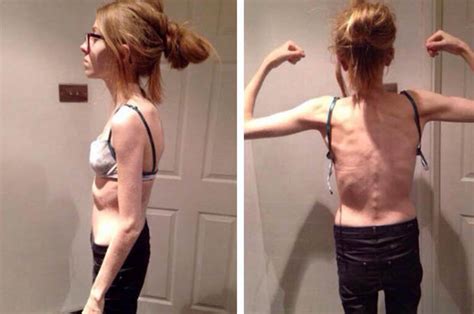 Girl Recovers From Life Threatening Eating Disorder After Weight Dropped To Just St Daily Star