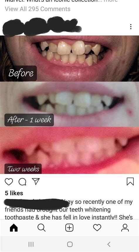 Clinically proven · 55 years of innovation · ada accepted How To Remove Tartar From Teeth Without Dentist Reddit ...