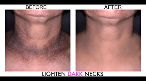 Dark Neck Home Remedies How To Get Rid Of Dark Neck Naturally In