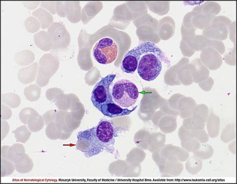 Plasma Cell Myeloma Cell Atlas Of Haematological Cytology