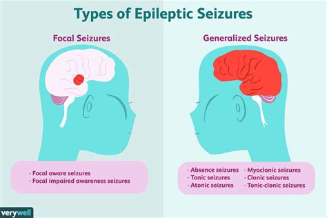 How Epilepsy Is Treated