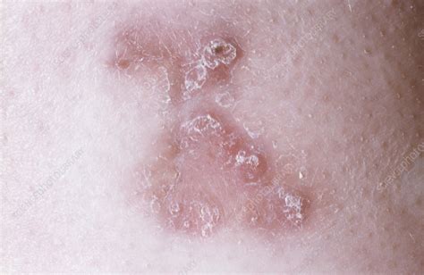 Cutaneous Tuberculosis Stock Image C0559815 Science Photo Library