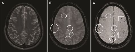 Scielo Brasil Current Contribution Of Diffusion Tensor Imaging In