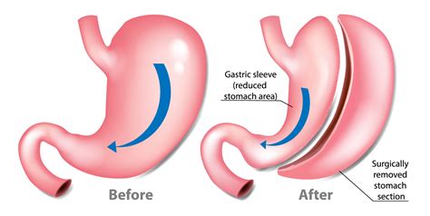 Gastric Sleeve Plano Tx Texas Center For Bariatrics Advanced Surgery