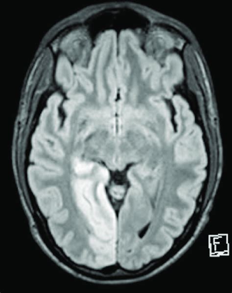 Mri Brain Diffusion Weighted Images Showing Occipital Ischaemic
