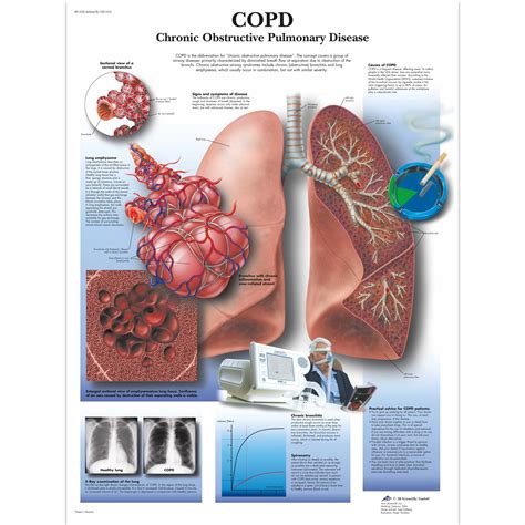 Lehrtafel COPD Chronic Obstructive Pulmonary Disease 4006678 3B