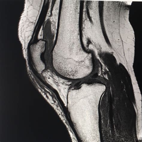 It may not display this or other websites correctly. Knie verdreht - Bänder beschädigt? MRT-Bilder bekommen ...
